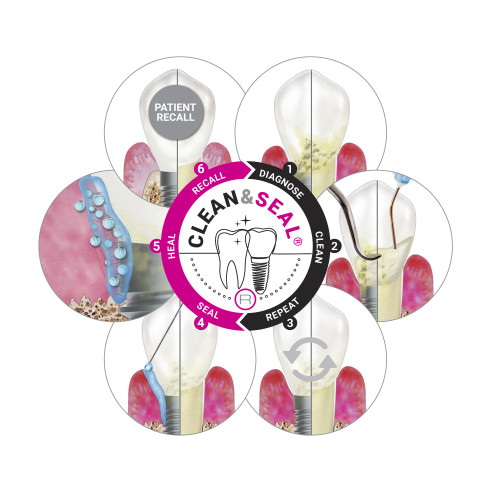 Pack Peri-implantite : Clean&Seal™